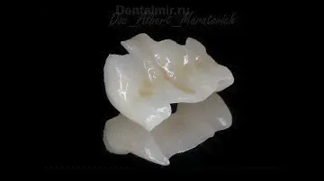 Керамическая вкладка, Cerec, Церек, Пломба, Кариес, Реставрация зубов,